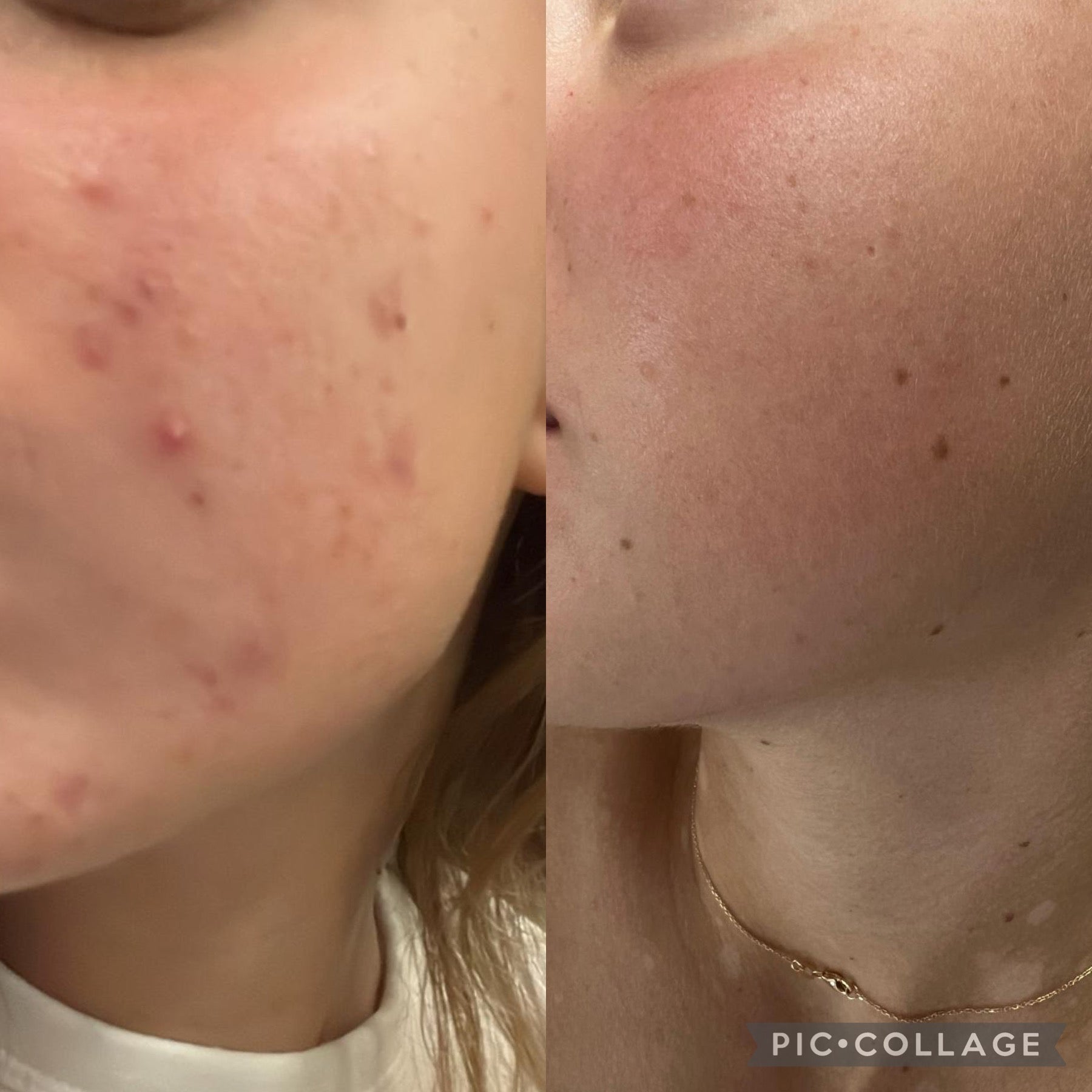 Acne Kit full treatment