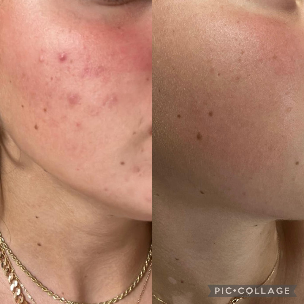 Acne Kit full treatment