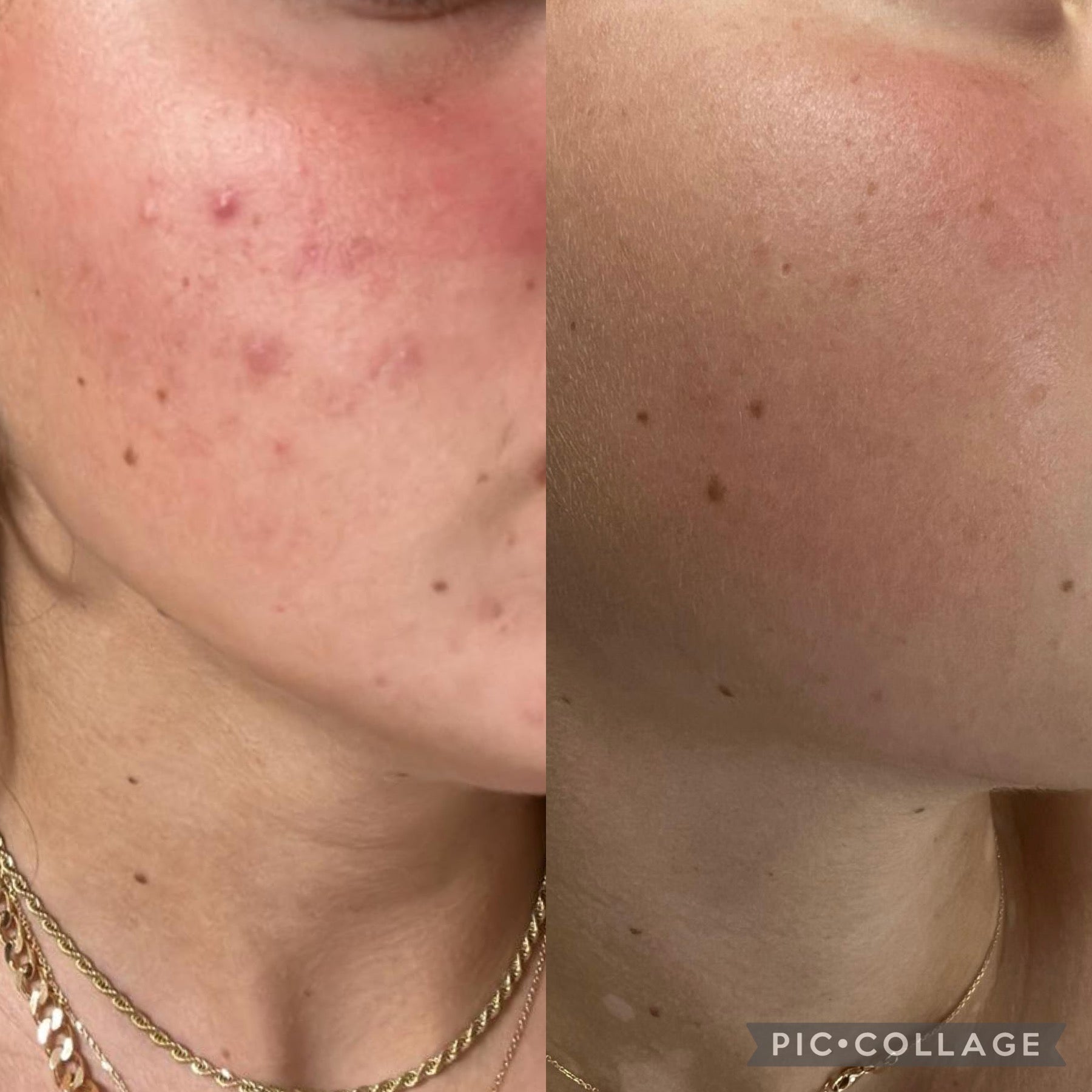 Acne Kit full treatment