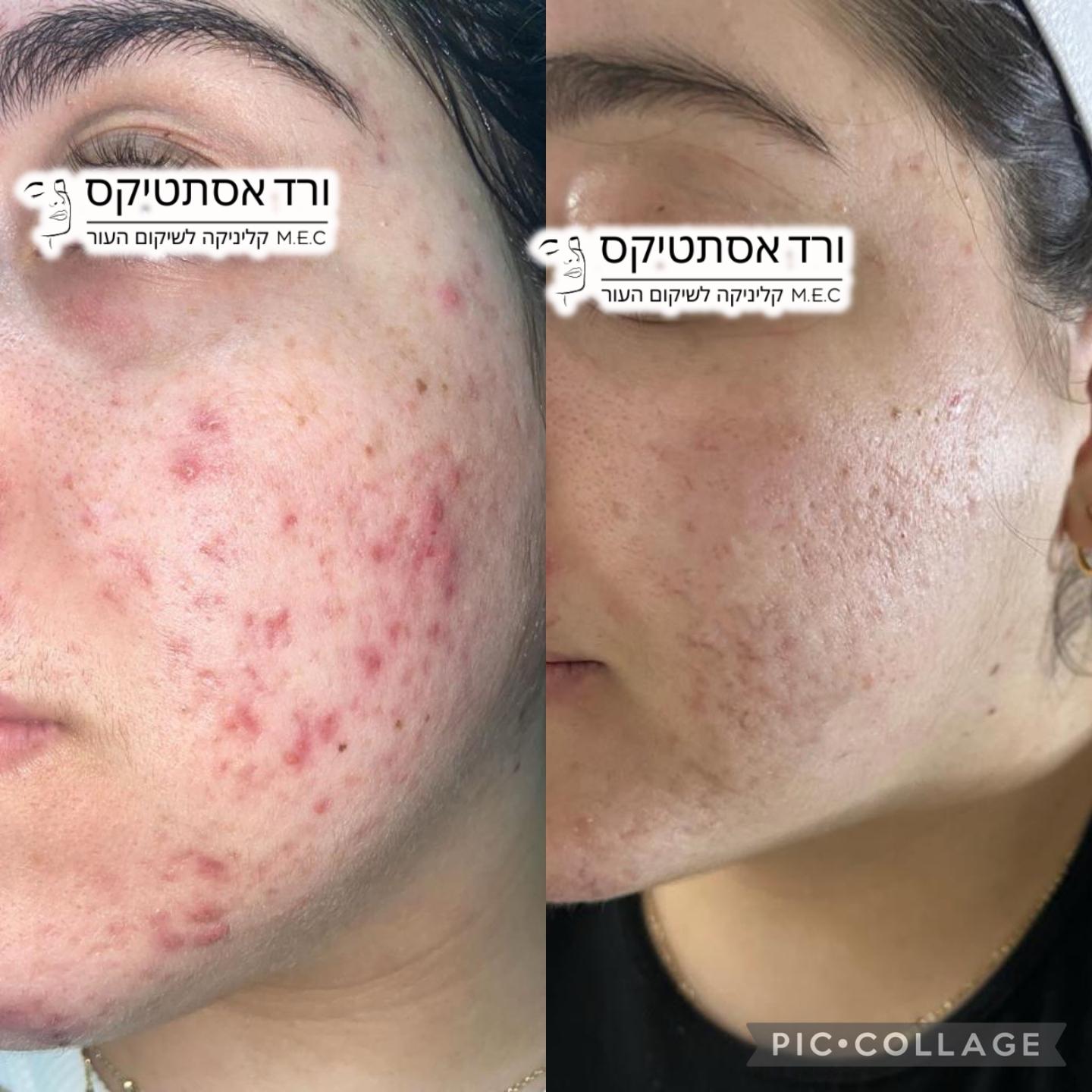 Acne Kit full treatment