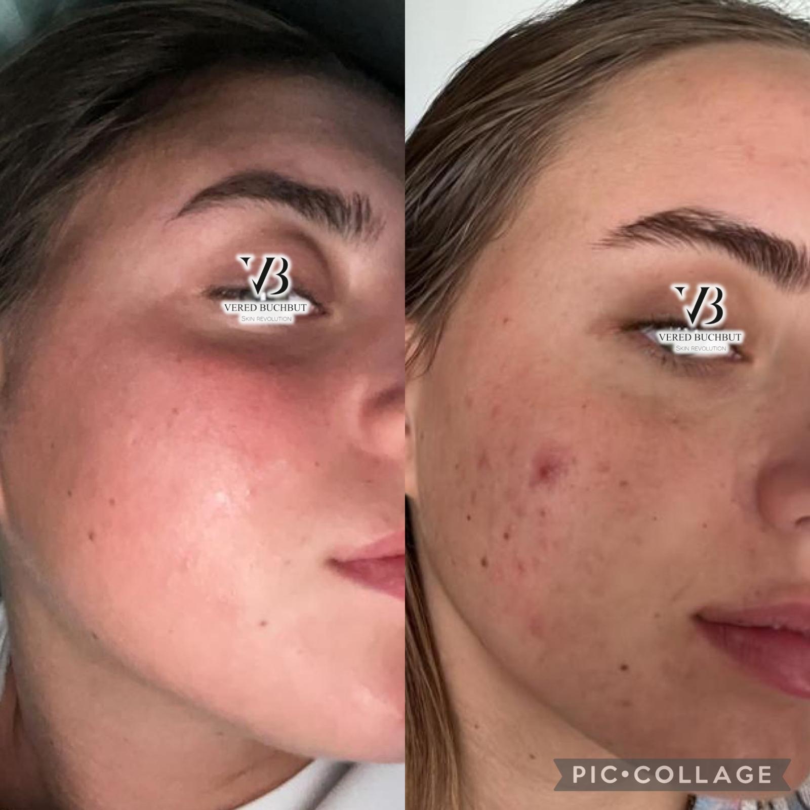 Acne Kit full treatment