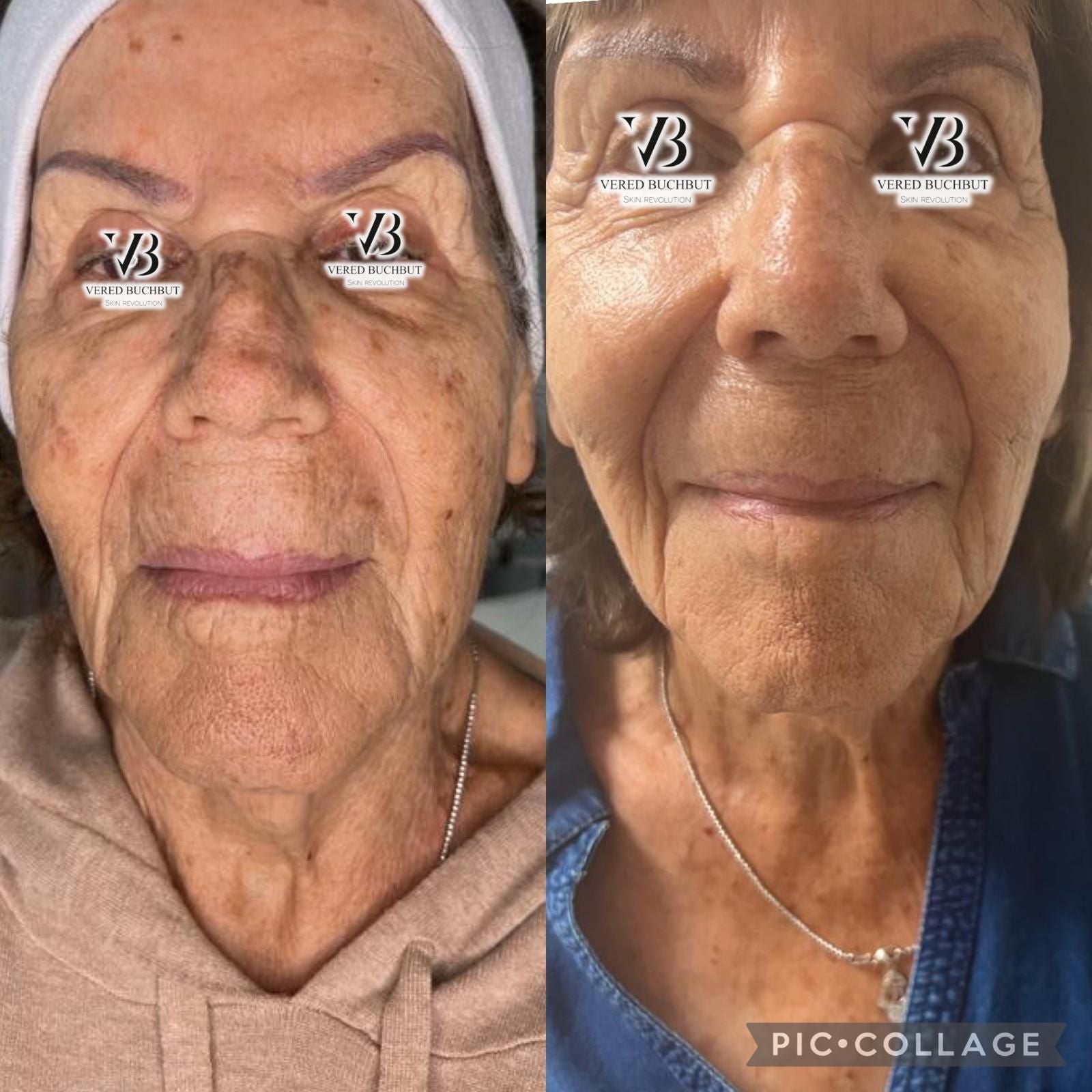 Whitening Kit Full Treatment