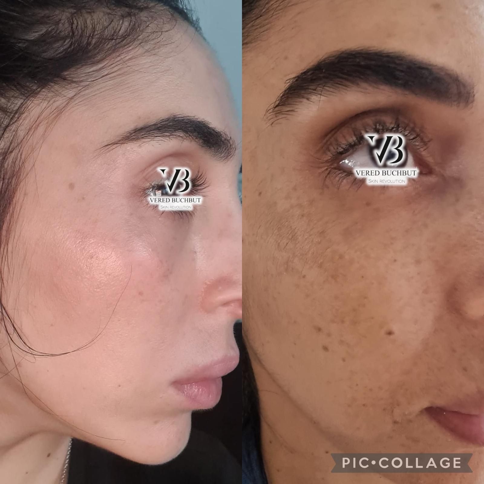 Whitening Kit Full Treatment