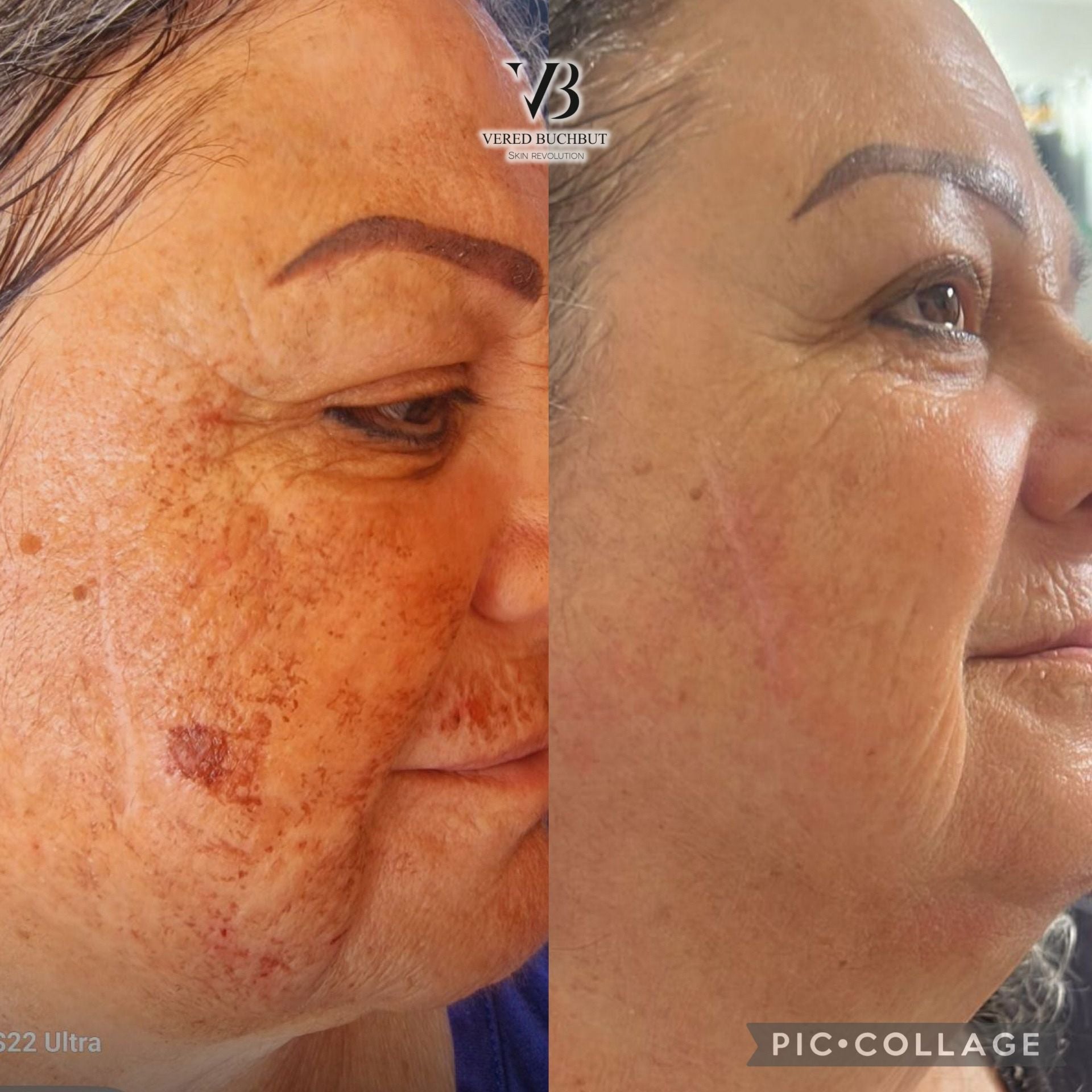 Whitening Kit Full Treatment